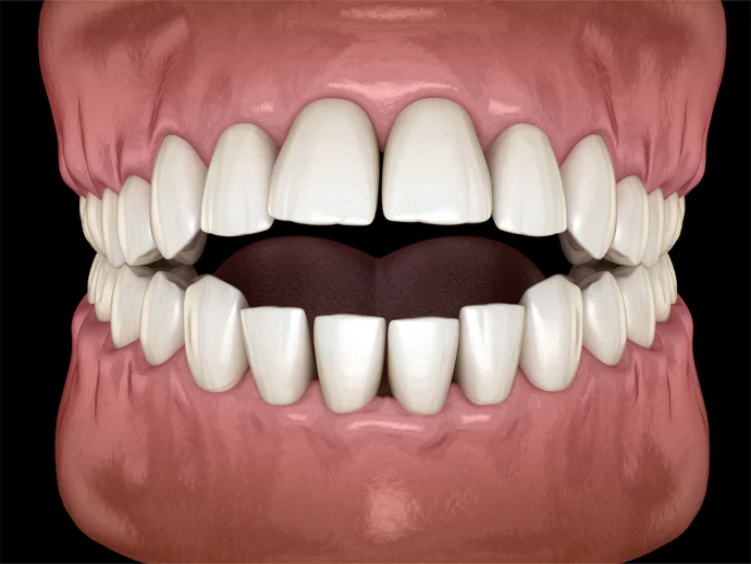 Open Bite Correction