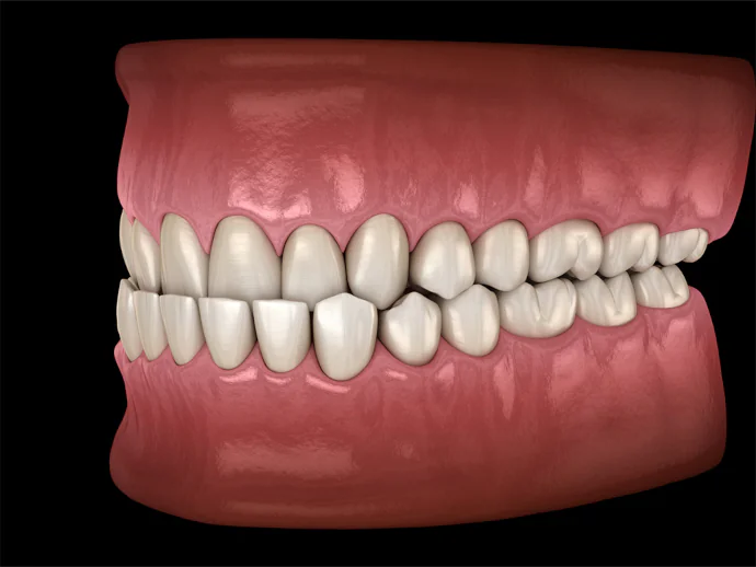 Underbite Correction